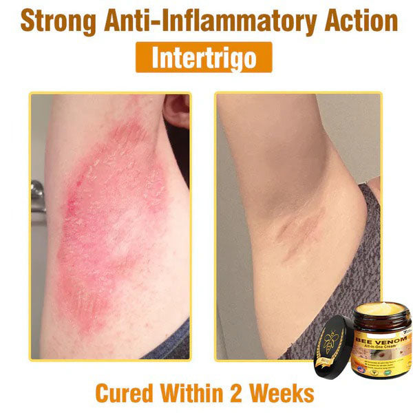 NATRAVOR® 𝐁𝐞𝐞 𝐕𝐞𝐧𝐨𝐦 𝐀𝐥𝐥-𝐢𝐧-𝐎𝐧𝐞 𝐂𝐫𝐞𝐚𝐦–🌸 Anti-aging,Hydrating, Skin Repair, Even Tone, Acne and Dark Spot Treatment, Wart and Mole Removal, Psoriasis Relief