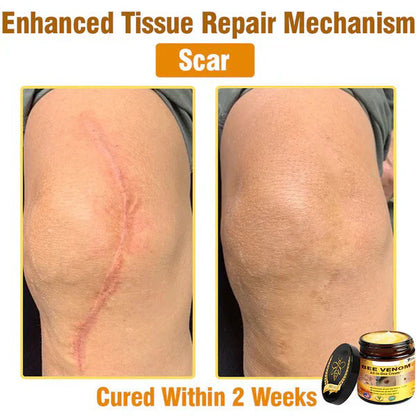 NATRAVOR® 𝐁𝐞𝐞 𝐕𝐞𝐧𝐨𝐦 𝐀𝐥𝐥-𝐢𝐧-𝐎𝐧𝐞 𝐂𝐫𝐞𝐚𝐦–🌸 Anti-aging,Hydrating, Skin Repair, Even Tone, Acne and Dark Spot Treatment, Wart and Mole Removal, Psoriasis Relief