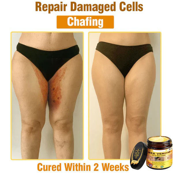 NATRAVOR® 𝐁𝐞𝐞 𝐕𝐞𝐧𝐨𝐦 𝐀𝐥𝐥-𝐢𝐧-𝐎𝐧𝐞 𝐂𝐫𝐞𝐚𝐦–🌸 Anti-aging,Hydrating, Skin Repair, Even Tone, Acne and Dark Spot Treatment, Wart and Mole Removal, Psoriasis Relief